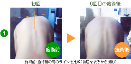 1.施術前・施術後の肩のラインを比較（前屈を後ろから撮影）