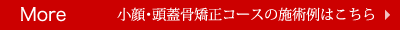 More 小顔・頭蓋骨矯正コースの施術例はこちら