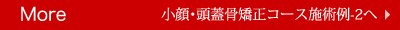 More 小顔・頭蓋骨矯正コース施術例-2へ